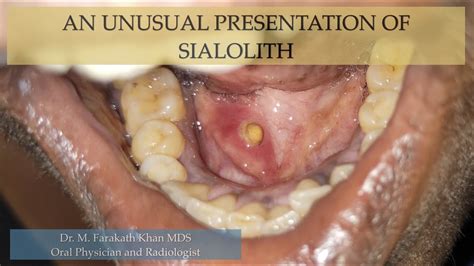 An Unusual Presentation Of Sialolith Youtube