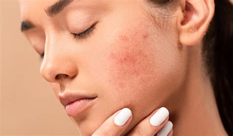 Skin Inflammation What Why And How To Treat It Be Beautiful India