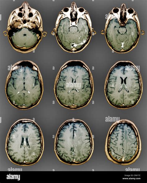 Normal Brain Mri Scans Stock Photo Alamy