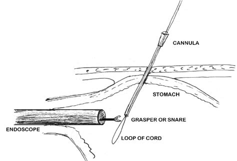 Depiction Of Peg Placement Adapted From Gauderer Ponsky And Izant