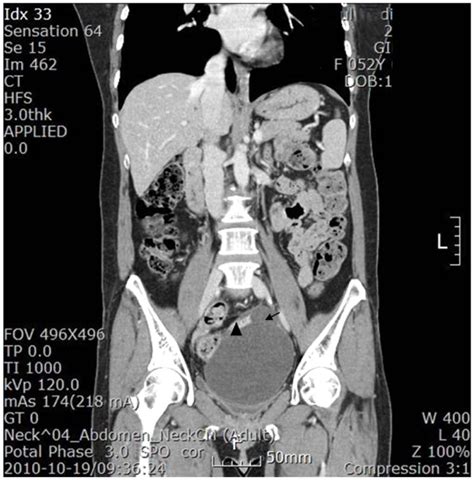 An Abdominopelvic Computed Tomographic Scan After Enhancement Shows A