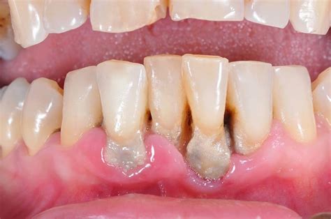 WHAT IS GUM INFECTION DISEASE New Smile Laser Dental