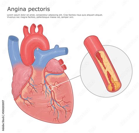 Angina Pectoris Medical Vector Illustration Human Heart And Blocked