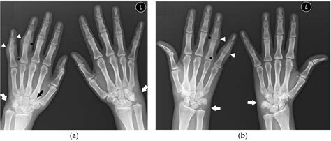 Jcm Free Full Text Hand And Wrist Involvement In Seropositive