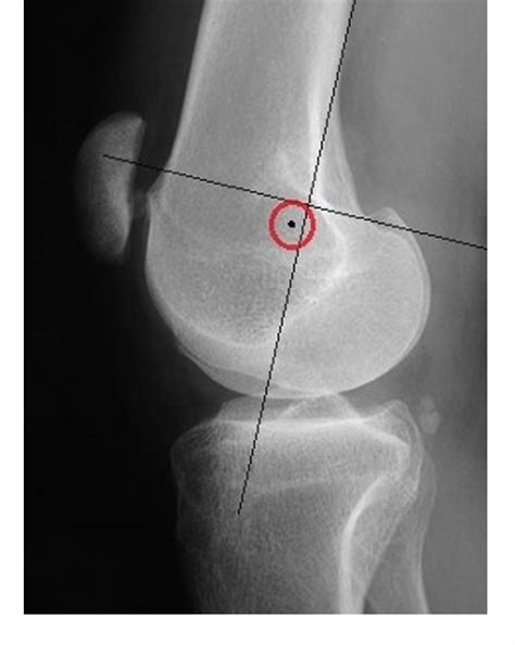 Figure 1 From Does Severity Of Femoral Trochlear Dysplasia Affect