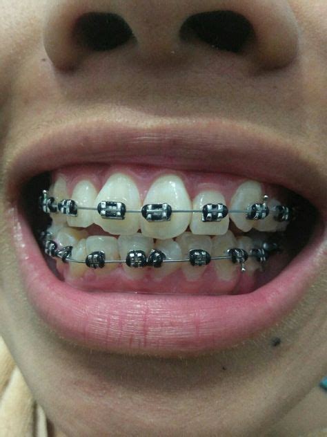 las 43 mejores imágenes de frenillos dentales frenillos dentales dental y brackets dentales