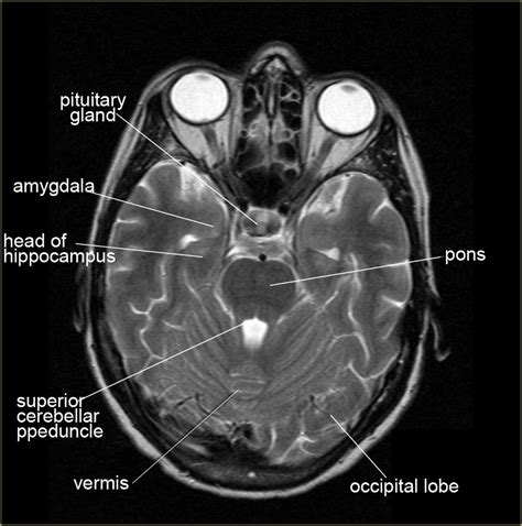 RM Cerebelo Radiologia