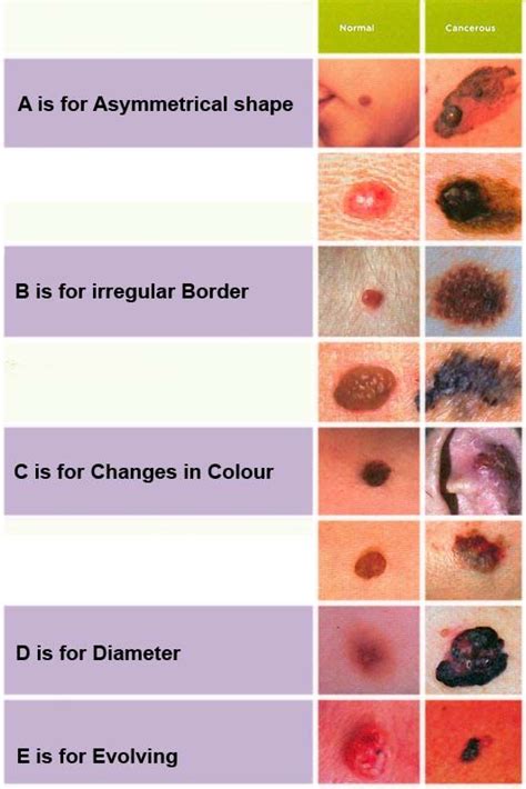 The 25 Best Cancerous Moles Ideas On Pinterest Pa Dermatology