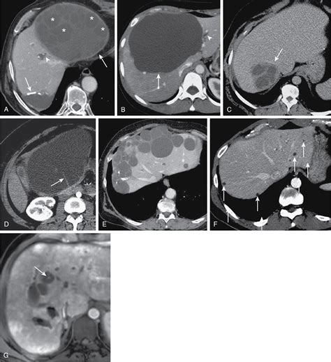 Benign Focal Liver Lesions Radiology Key