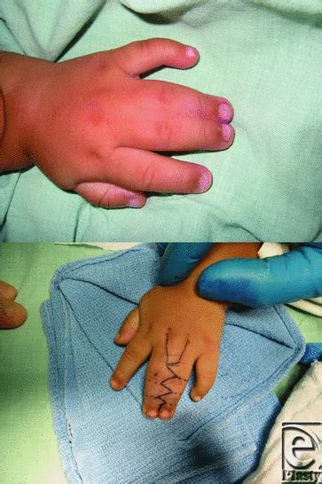 Syndactyly Repair