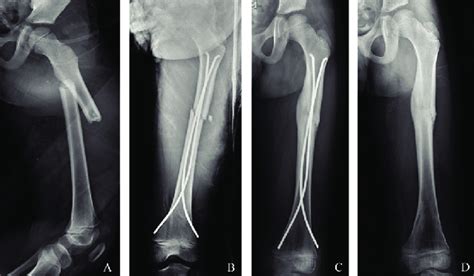 Typical Pediatric Femoral Shaft Fracture A Treated With Esin Fixation