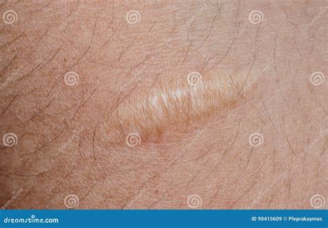 Keloid Scar On Skin Background Stock Image Image Of Scarred Keloid