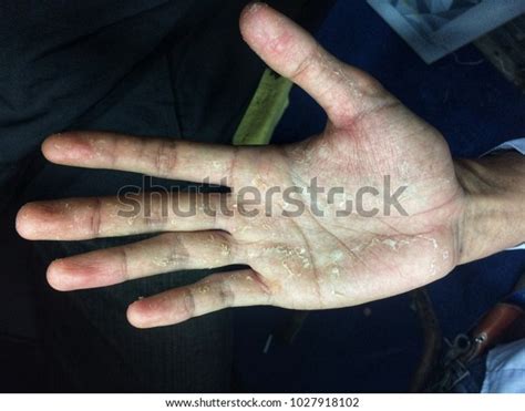 Hand Skin Peeling Due Allergic Reaction Stock Photo 1027918102