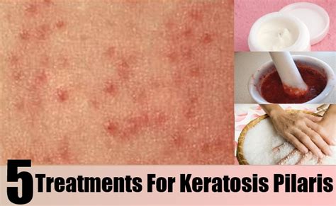 5 Treatments For Keratosis Pilaris Lady Care Health