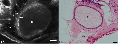 Fibrocystic Changes Cslm A And Hande B Images Show The Lumen Of A