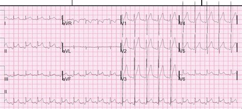 It's not usually serious, but it can cause serious health problems. EKG: Pericarditis vs. STEMI - Rush Emergency Medicine
