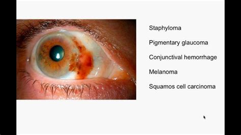 Pigmentary Glaucoma Icd Astigmatism Glaucoma Swollen Eyes Disease My
