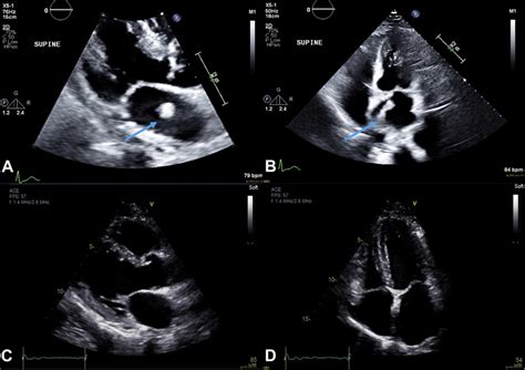 Transthoracic Echocardiogram Showing The Parasternal Long Axis Left Download Scientific