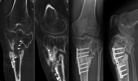 Preoperative Ct And Radiographs Showing Posttraumatic Lateral Tibial