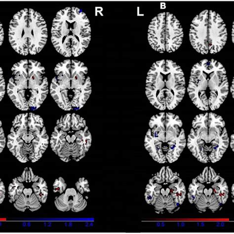 Gray Matter Differences Between Patients A And Relatives Of Patients