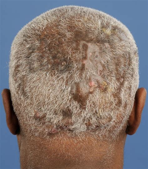 Alopecia Atrophicans Scarring Alopecia Cicatricele Alopecia