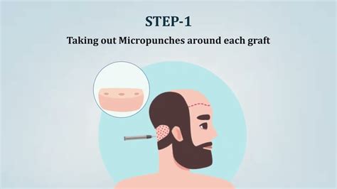 Fue Hair Transplant Technique Most Advanced Hair Transplant Technique Derma Magnetica Clinic