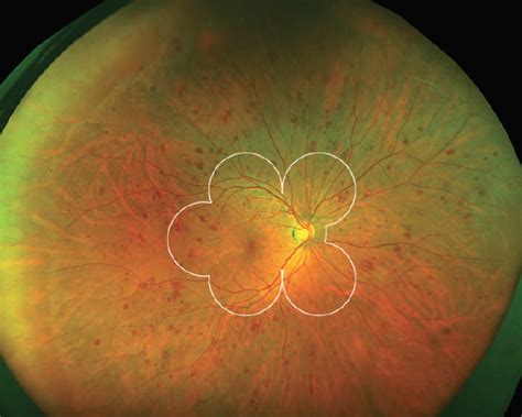 How Protocol Aa Fits Into Evolution Of The Diabetic Retinopathy