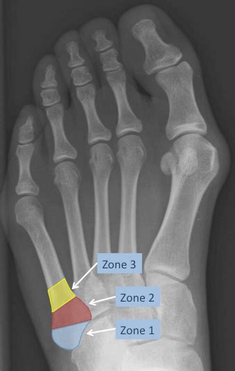 5th Metatarsal Fracture