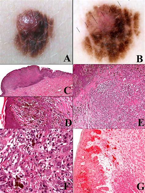 Frontiers The Who 2018 Classification Of Cutaneous Melanocytic