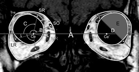 Magnetic Resonance Imaging Measurements Of Extraocular Muscle Path