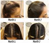 Hair Loss Treatment Chicago Images
