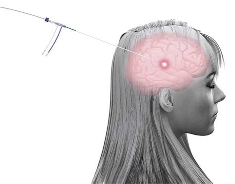 Expert Alert Laser Therapy Brings The Heat To Minimally Invasive Epilepsy Treatment EpilepsyU