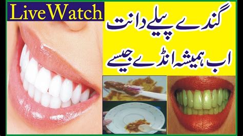 Traditional appliances are made of metal, which causes great inconvenience for the patients. How To Get Rid Dirty Yellow Teeth In Just 2 Minutes In ...