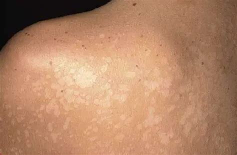 White Spots On Skin From Sun