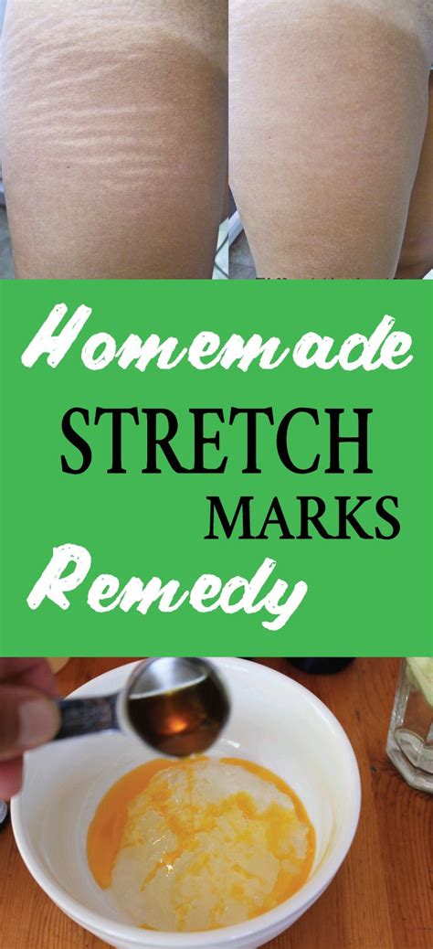 Homemade Stretch Marks Remedy Naturale