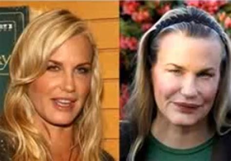 17 Celebrity Before And After Plastic Surgery Disasters