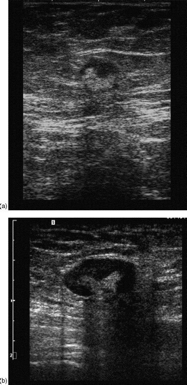Ultrasound Of Superficial Lymph Nodes European Journal Of Radiology