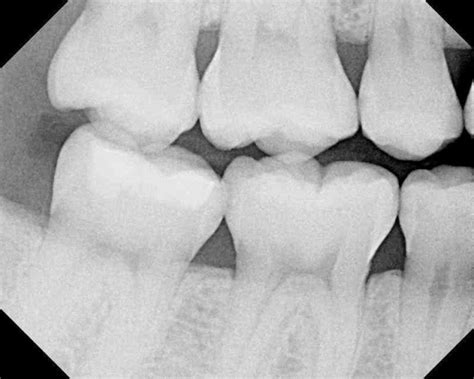 Caries Detection What Do You See Spear Education