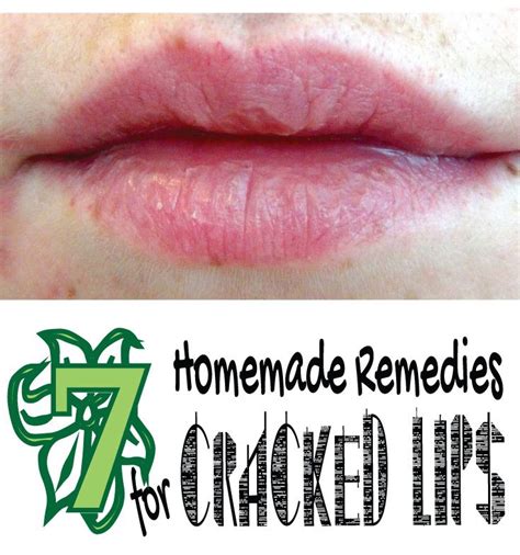 7 Homemade Remedies For Cracked Lips Natural Healing Remedies Cold