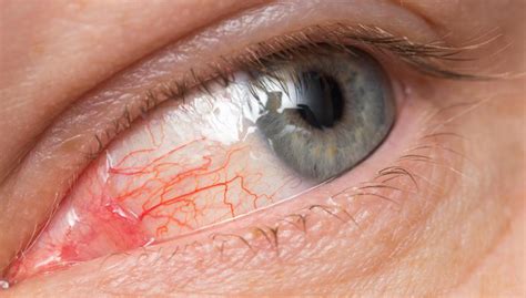 Pink Eye What You Need To Know Vital Record