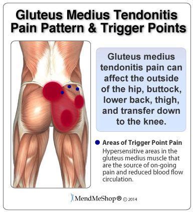 Tight quad muscles may be underlying your back pain. Gluteus medius tendonitis pain can affect the outside of ...