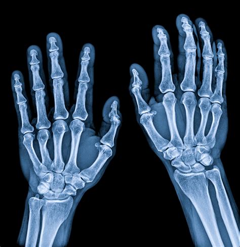 New Clues On Tissue Damage Identified In Rheumatoid Arthritis And Lupus