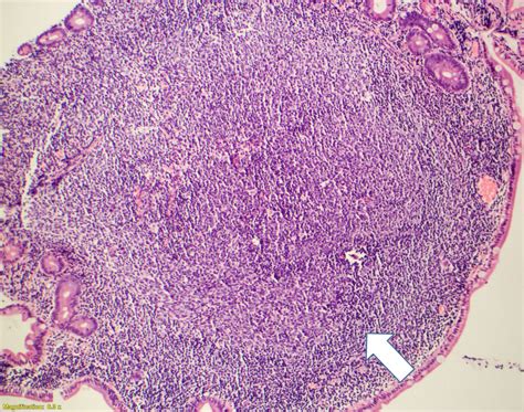 Pathology Outlines Follicular Lymphoma Duodenal Type