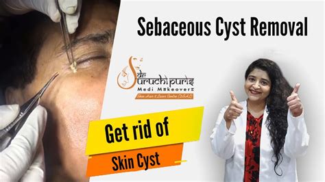 Sebaceous Cyst Removal Near The Eye Dr Suruchi Puris Medi Makeovers