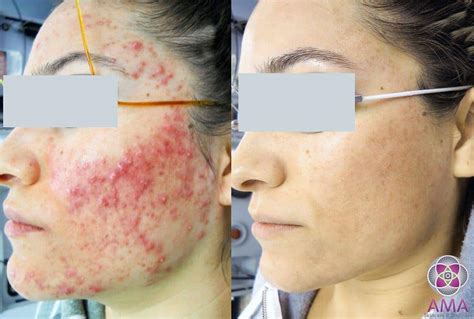 Cystic Acne Treatment Laser Treatments For Acne