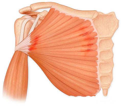 Pectoralis Major Tear Syndrome Photograph By Medical Imagery Studios