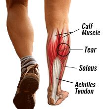 Calf Muscle Tears Symptoms Complications And Treatments Physio Fit