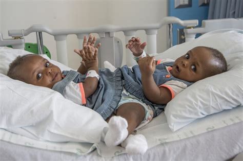 Conjoined Nigerian Twins Finally Separated Photos Health Nigeria