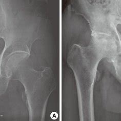 (PDF) Subchondral Insufficiency Fracture of the Femoral ...