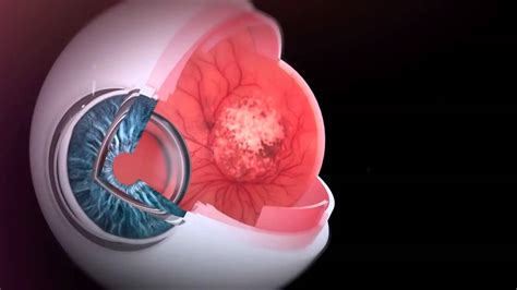 Crizal Prevencia A journey into eye health - YouTube